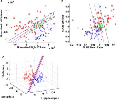 Prospective Quantitative Neuroimaging Analysis of Putative Temporal Lobe Epilepsy